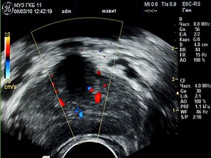 Ultrasound showed foci of inflammation in the prostate