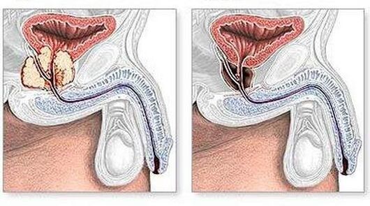Before and after the treatment of chronic surgically prostatitis