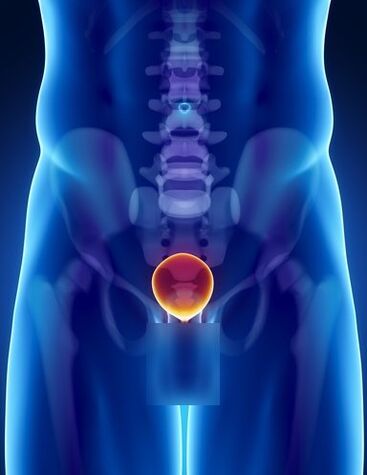 Inflammation of the prostate in a man with prostatitis