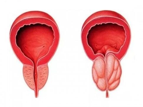 Healthy and fiery prostate